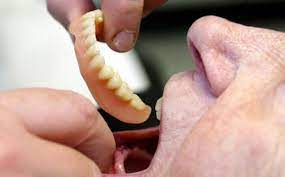 Beberapa obat tertentu seperti antibiotics doxycycline dan tetracycline dapat menghitamkan gigi. Gigi Palsu Porcelain Berubah Kehijauan Setelah 2 Tahun Bisa Diperbaiki Spesialis Orthodonti Tribunnews Com Mobile