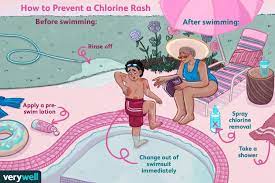 chlorine rash symptoms treatment and