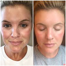 laser treatment microneedling results