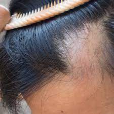 Alopecia Areata > Fact Sheets > Yale ...
