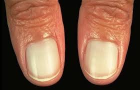 10 fingernail issues and what they mean