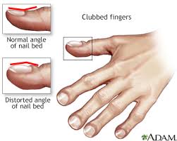clubbing of the fingers or toes