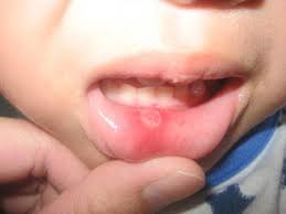 Image result for petua merawat ulser lidah