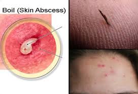 The rash may appear as pimples that come to white tips on the face. Boils Pictures Causes Symptoms And Treatment