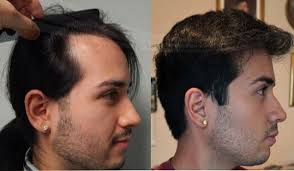 Cani get it in uk and how much or if not is there any other weave i can use that is similar to this. Hair Transplants The Definitive Guide For Men In 2021