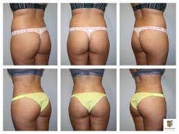 How much does a bbl cost in houston? Brazilian Butt Lift 360 Lipo Mansfield Arlington Dallas Ft Worth