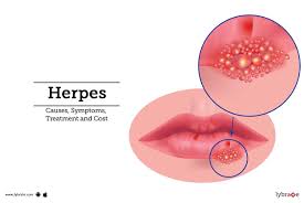 herpes causes symptoms treatment and