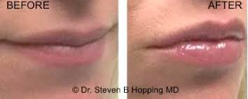 fat transfer for face lips hands