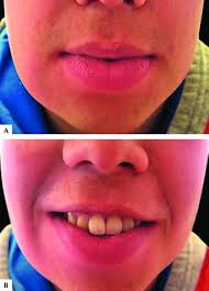 asymmetrical lower lip swelling