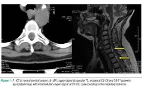 A magnetic resonance imaging (mri) scan on the third day after the onset of symptoms revealed a subdural hematoma from l1 to s1, presenting as epidural and subdural spinal hematomas were previously diagnosed by myelography and computed tomography (ct). Spine Subdural Hematoma A Rare Complication Associated With Vitamin K Antagonist Vka