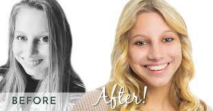 before and after braces face shape