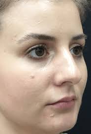 liquid rhinoplasty before and after