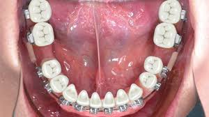 If extracted before adjacent moved they may or may not return to their natural positions. How Long Do Braces Take To Close Extraction Gaps