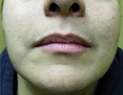 lips tear trough shaping or