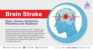 brain stroke types causes symptoms