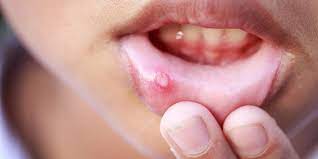 Treating Cold Sores and Canker Sores in Mouth - Dental Care of Mesa