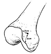 fem shaft fractures trauma