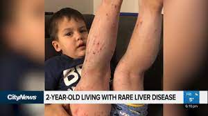toddler with rare liver disease ...