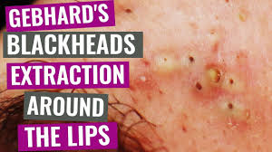 blackheads extraction around the lips