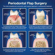 periodontal flap surgery coastal