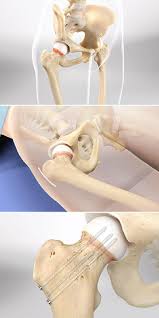 hip fracture treatment with surgical