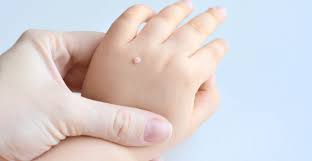 what causes warts dermatology and