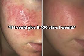15 s for cystic acne our readers