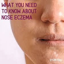 how to treat nose eczema
