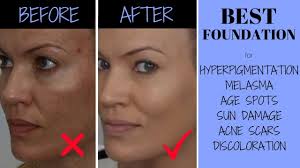 hyperpigmentation melasma acne scars