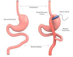 gastric byp all information and cost