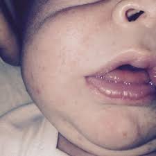 help blister on baby s lip