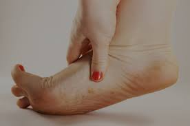 foot eczema vs athlete s foot