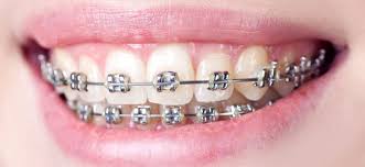 We did not find results for: Traditional Dental Braces Vs Invisalign Aligners Consumer Guide To Dentistry