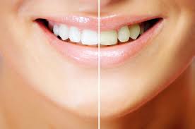 Whitening strips for continued whitening. Tips And Myths For Teeth Whitening At Home