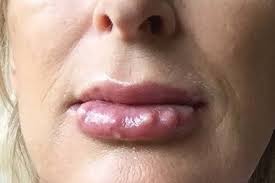late onset lip nodules 4 months after