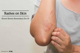 rashes on skin know home remes for