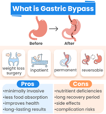 gastric byp surgery how it works