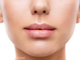 lip augmentation in iran lip fillers