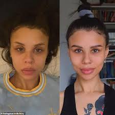 Bags under the eyes are usually a cosmetic concern and do not require medical attention, but their appearance can be bothersome to some people. Women Are Getting 800 Under Eye Bag Filler To Remove Dark Circles Daily Mail Online