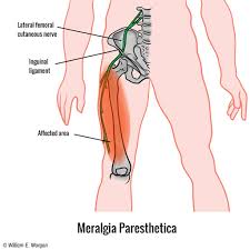 meralgia paresthetica treatment