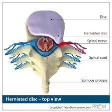 Tricities Spine Bristol Tn Herniated Disc Spine Problems