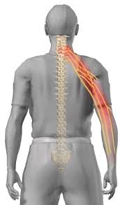 pinched nerve neck physiotherapy
