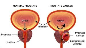 These include your blood pressure, heart rate and metab. Prostate Cancer Symptoms Diagnosis Treatment Everyday Health