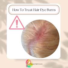 how to treat hair dye burns scalp