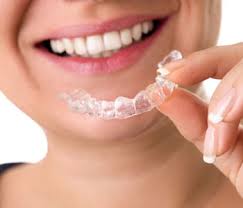 Adult Dental Braces at Reasonable Prices