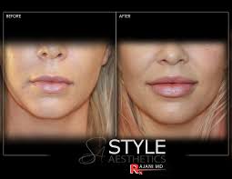 lip augmentation filler before after