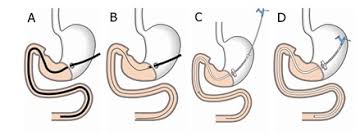 percutaneous endoscopic gastrostomy