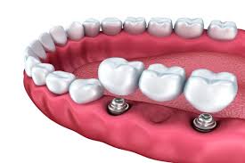 what is an implant supported bridge
