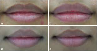 hyperpigmented lip