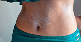 hives on stomach causes treatments